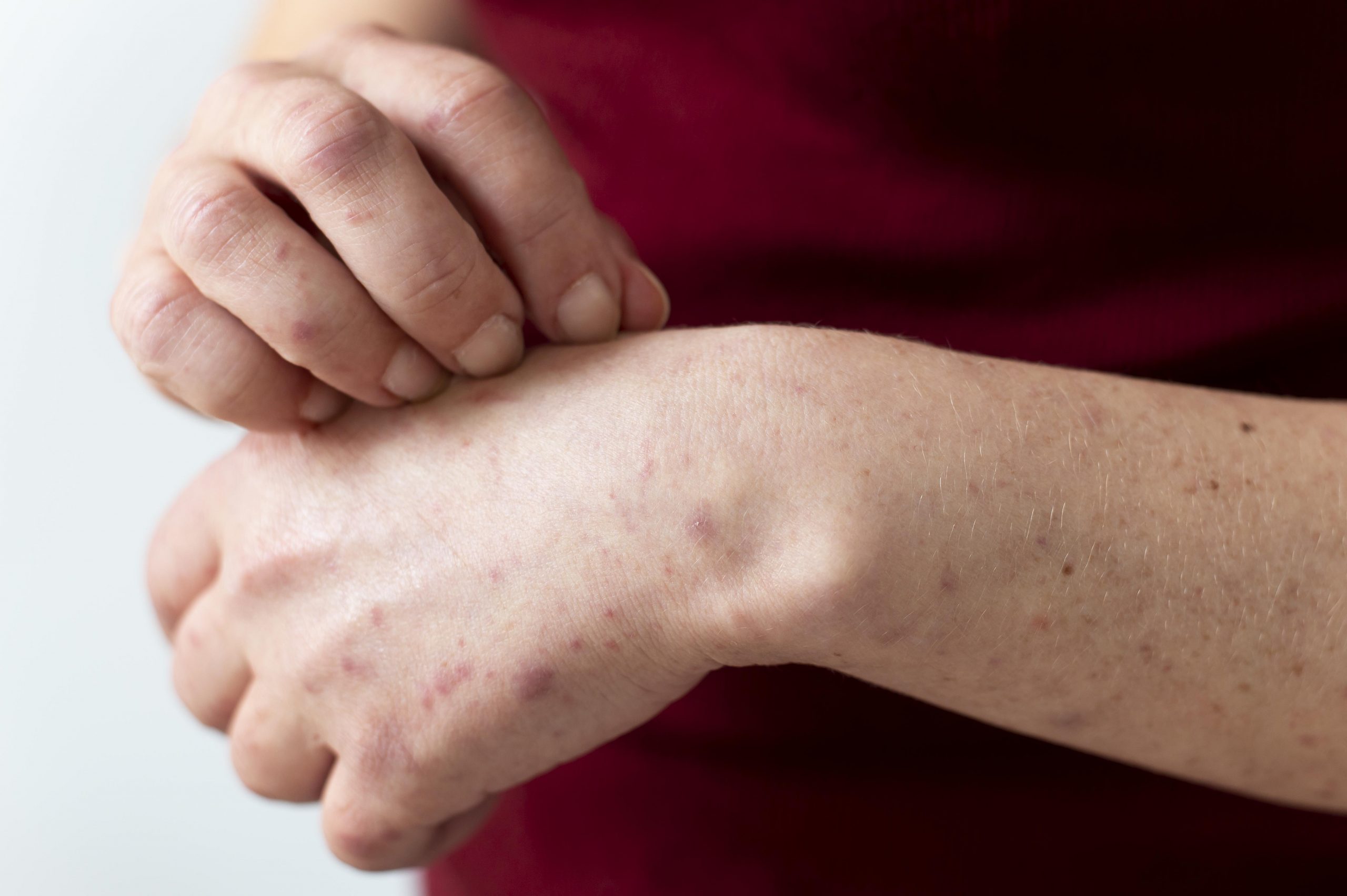 Dermatite de contato alérgica e irritativa são as formas mais comuns