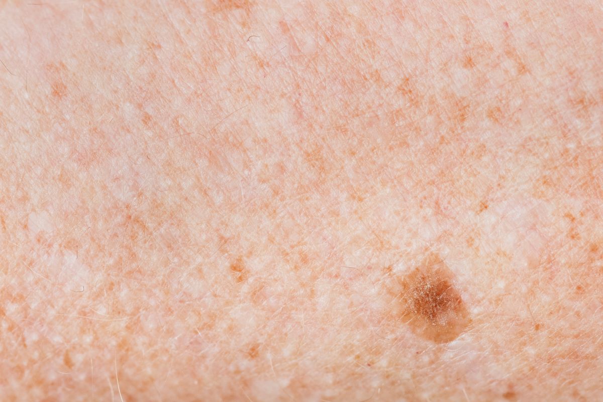 Melanoma: avanços e atenção constante!