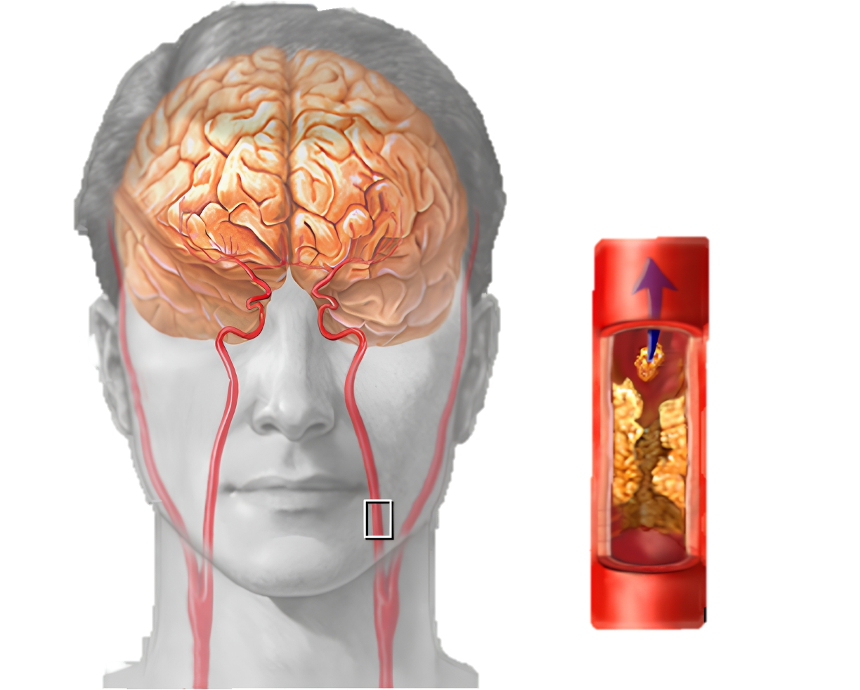 Obstrução das carótidas provoca sequelas neurológicas graves