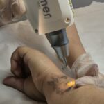 Arrependimento da tattoo ou da sobrancelha? Saiba como funciona a despigmentação a laser Despigmentacao-a-laser-LypeDepyl-credito-divulgacao (1)