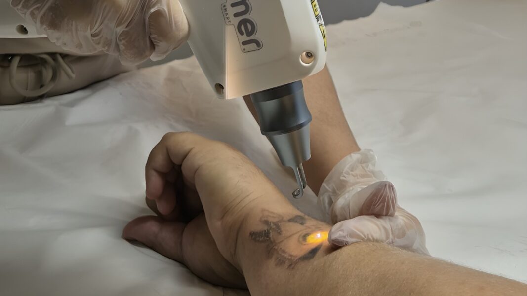 Arrependimento da tattoo ou da sobrancelha? Saiba como funciona a despigmentação a laser
