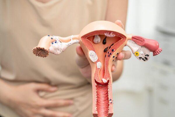 Endometriose afeta mais de 7 milhões de brasileiras e pode levar anos para ser diagnosticada