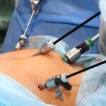 Operation on the stomach. Medical procedure for treating a patient with a surgical intervention in the operating room